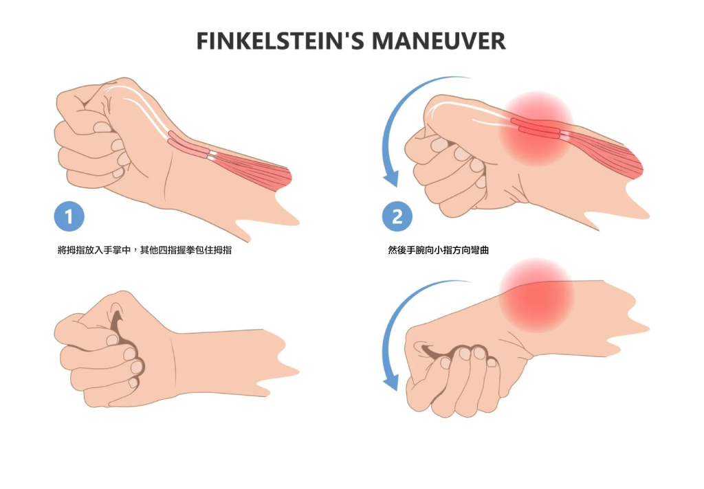 Finkelstein’s Test,芬可斯坦測驗,媽媽手,物理治療