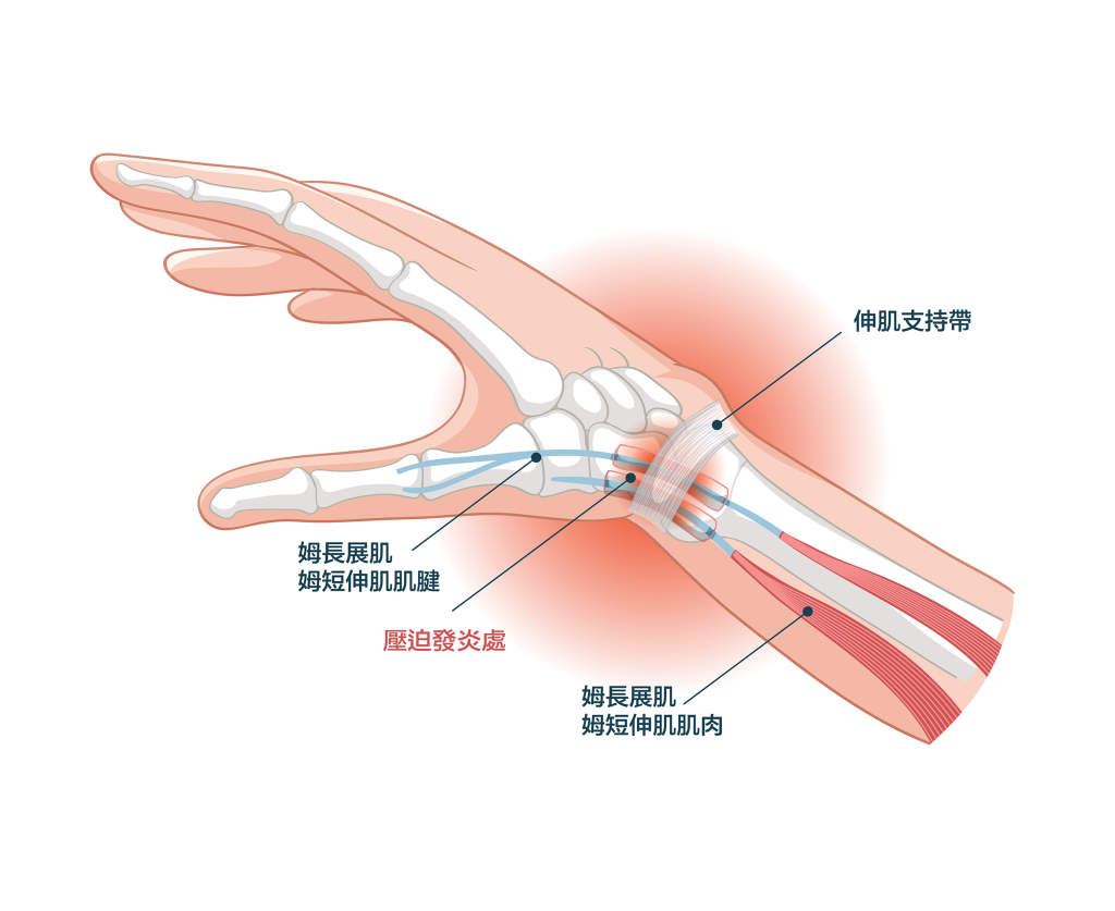 De Quervain's Tenosynovitis,媽媽手,物理治療,手腕痛