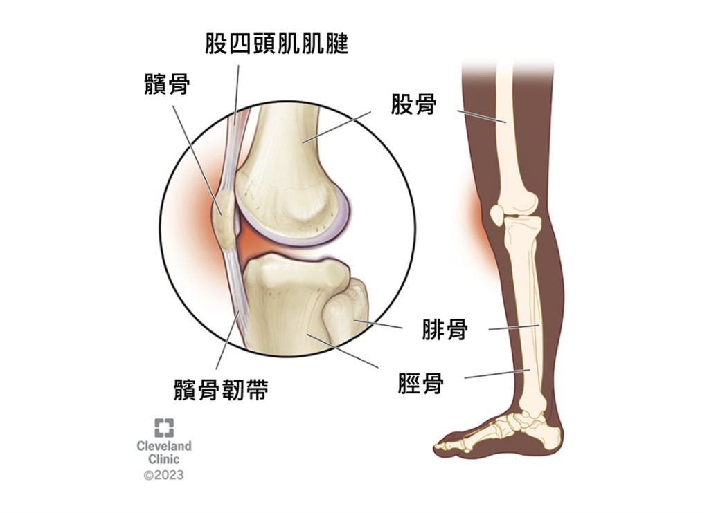 膝蓋痛,膝關節,髕骨股骨症候群,物理治療